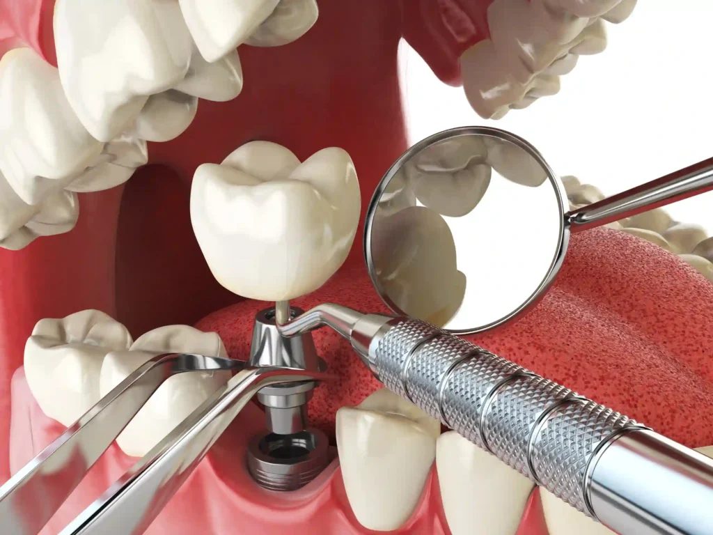 Implant Tedavisinde Başarı Oranı