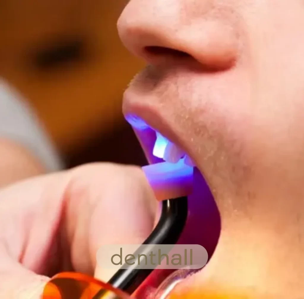 Bonding Uygulaması Nasıl Yapılır